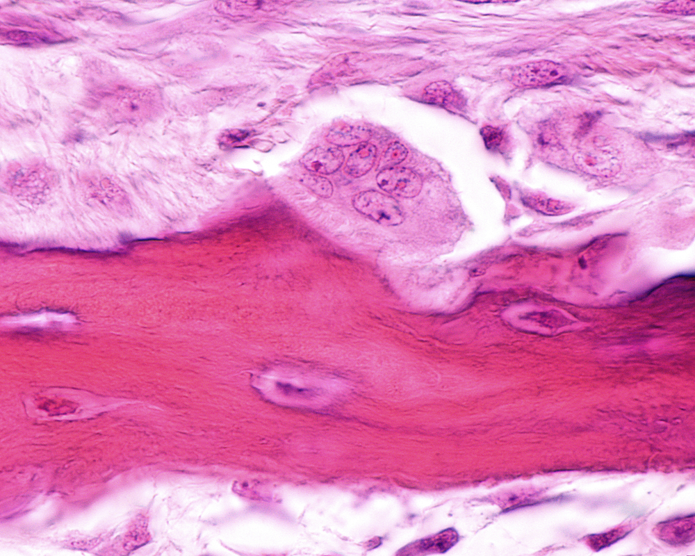 thrombocytopenia research thrombocytopenia research